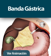 Bnada Gástrica