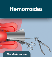 Hemorroides